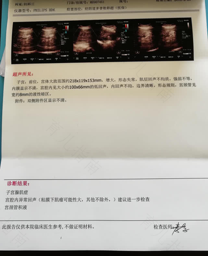 子宫肌瘤多大可以摸出来