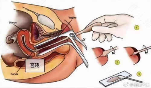 宫颈筛查的步骤是什么 宫颈筛查的步骤是什么