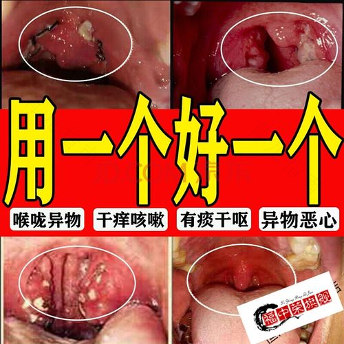 一到晚上就咽喉痒咳嗽是怎么回事 一到晚上就咽喉痒咳嗽是怎么回事