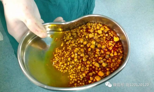 胆结石能不能吃土豆丝