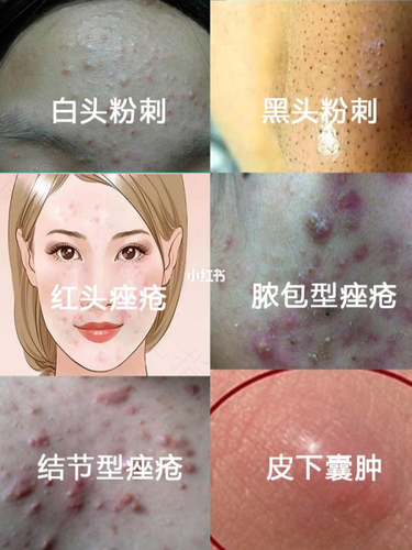 鼻头有黑点怎么去掉 鼻头有黑点怎么去掉