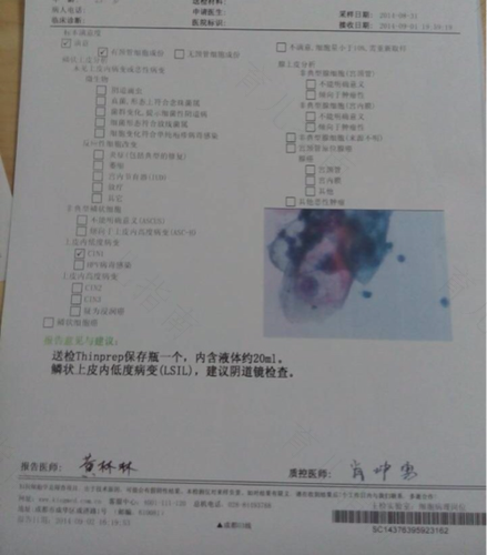 宫颈筛查低度鳞状上皮内病变 宫颈筛查低度鳞状上皮内病变