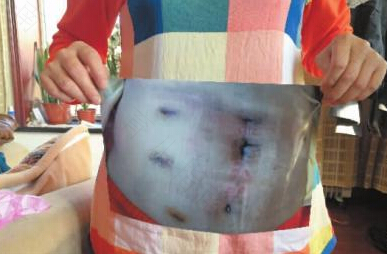 子宫穿孔需要开腹手术吗 子宫穿孔需要开腹手术吗