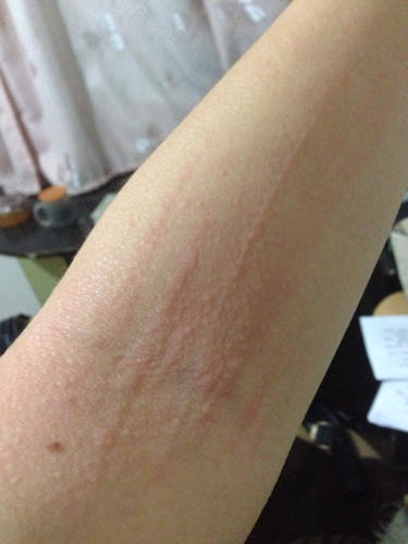 大半夜全身过敏怎么办