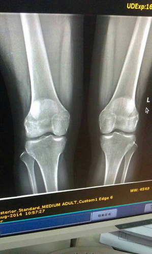 怎样判断骨骼线是否闭合? 怎样判断骨骼线是否闭合?