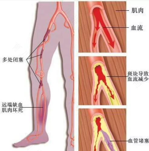 腿部动脉硬化怎么治啊 腿部动脉硬化怎么治啊