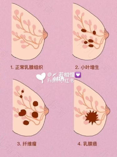 副乳乳头可以切除吗 副乳乳头可以切除吗