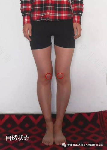 什么叫o型腿什么叫x腿