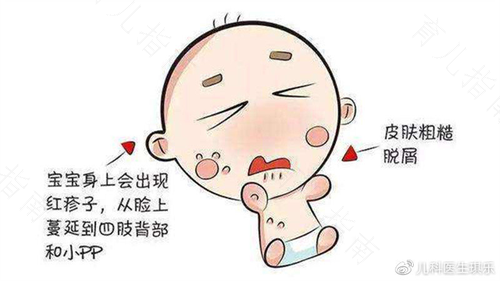 四大神奇攻略 消除宝宝湿疹
