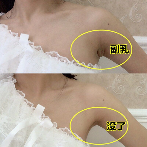 腋下长副乳有什么危害 腋下长副乳有什么危害