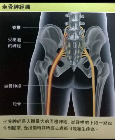 经常坐骨神经痛是怎么回事 经常坐骨神经痛是怎么回事