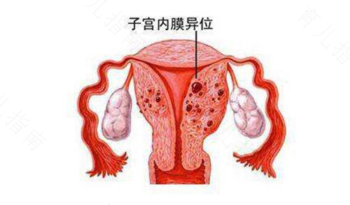 始基子宫没有内膜能治疗吗