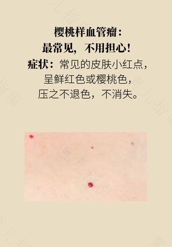 冬天身上起红斑是怎么回事 冬天身上起红斑是怎么回事