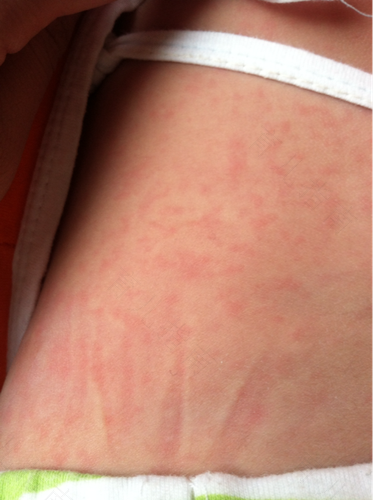 最近身体老是过敏怎么回事 最近身体老是过敏怎么回事