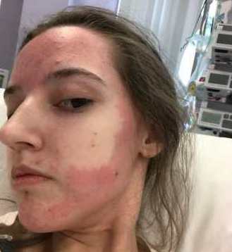 食物过敏在几个小时内出现 食物过敏在几个小时内出现