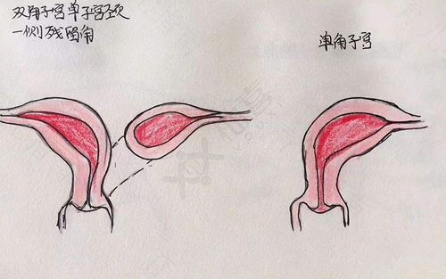 子宫体增大是什么原因造成的 子宫体增大是什么原因造成的