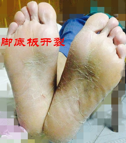 脚底皲裂开口怎么办 脚底皲裂开口怎么办