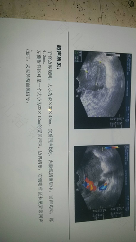 子宫附件区囊肿是什么意思 子宫附件区囊肿是什么意思