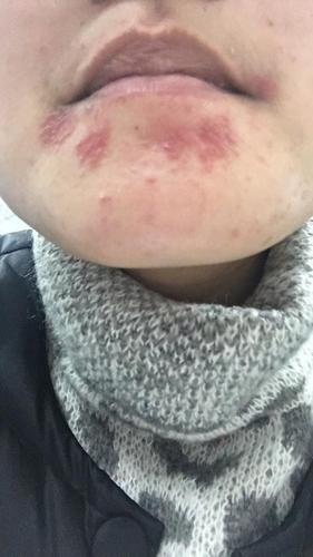 干性湿疹会长在脸上吗 干性湿疹会长在脸上吗