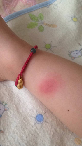 虫虫飞,虫虫咬,皮肤过敏真烦恼 虫虫飞,虫虫咬,皮肤过敏真烦恼