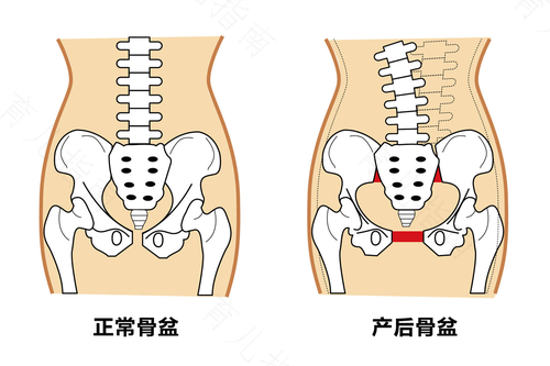 骨盆修复需要几个疗程 骨盆修复需要几个疗程