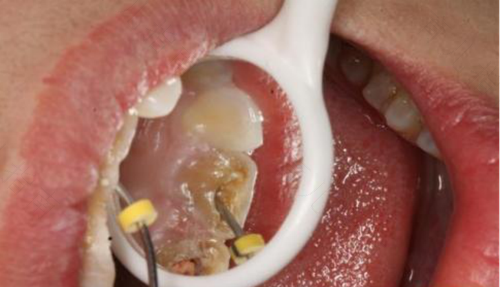 蛀牙了有个大洞牙痛怎么办怎么缓解 蛀牙了有个大洞牙痛怎么办怎么缓解