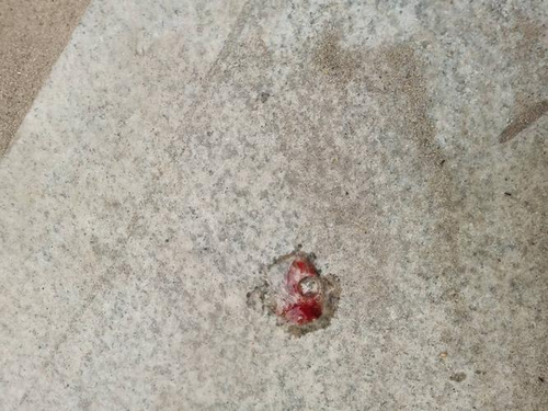 单纯性鼻炎会有血丝吗