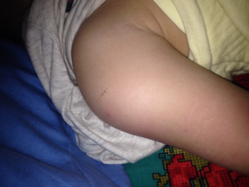 宝宝打了百白破发烧怎么办