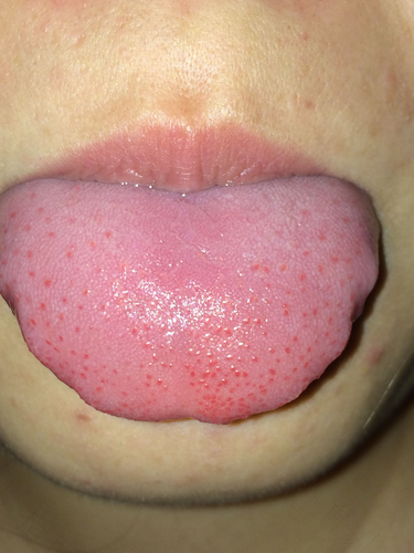 舌头有齿痕是怎么回事? 舌头有齿痕是怎么回事?