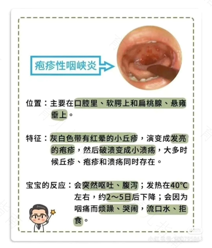 鹅口疮和奶泡的区别图片 鹅口疮和奶泡的区别图片