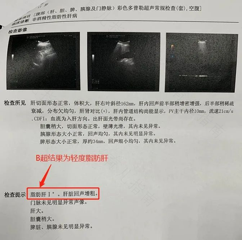 轻度脂肪肝怎么办?