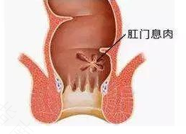 痔疮会导致肛门瘙痒吗 痔疮会导致肛门瘙痒吗
