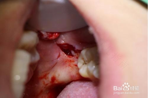 拔智齿之后一般疼几天能好 拔智齿之后一般疼几天能好