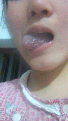 感冒会导致舌苔发黑吗 感冒会导致舌苔发黑吗