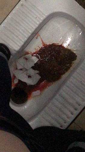 什么是痔疮图片 什么是痔疮图片