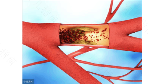 脑动脉硬化能恢复过来吗 脑动脉硬化能恢复过来吗
