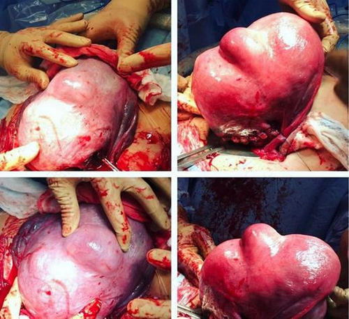 怎么知道子宫有没有肿瘤 怎么知道子宫有没有肿瘤