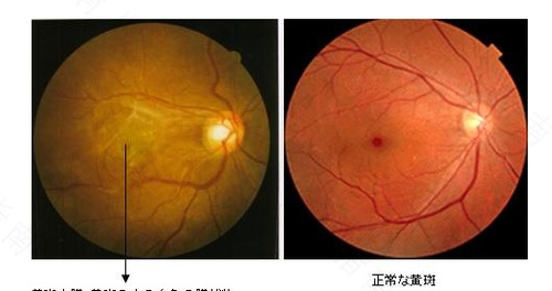怎样治疗黄斑病变 怎样治疗黄斑病变