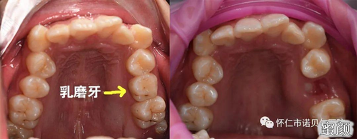 上颚最里面牙齿好拔吗 上颚最里面牙齿好拔吗