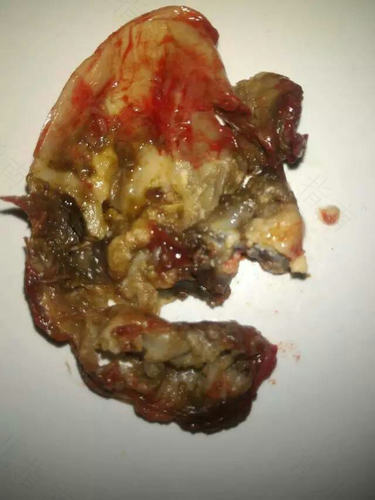 宫颈肥大二度糜烂严重吗 宫颈肥大二度糜烂严重吗