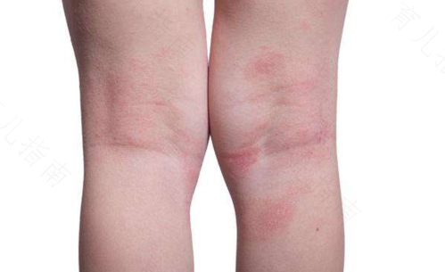 身上起湿疹怎么治疗 身上起湿疹怎么治疗