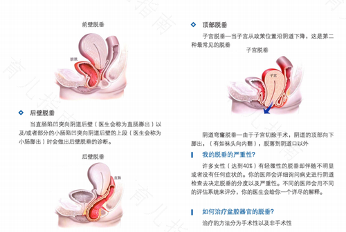 子宫脱垂怎么检查出来