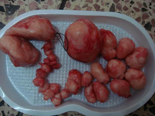 子宫肌瘤不可以吃大枣吗 子宫肌瘤不可以吃大枣吗