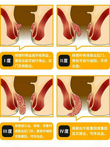痔疮术后大出血的应急预案 痔疮术后大出血的应急预案
