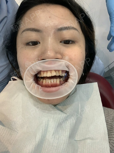 拔完牙多久可以矫正? 拔完牙多久可以矫正?