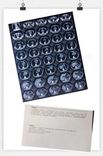 cta造影剂副作用的危害 cta造影剂副作用的危害