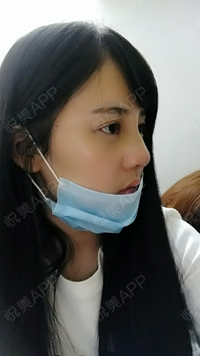 鼻综合两个月能喝酒吗 鼻综合两个月能喝酒吗