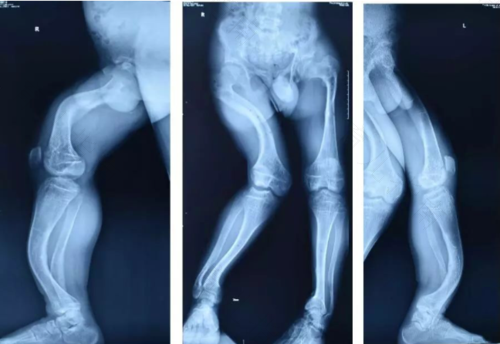 抗维生素d佝偻病是什么遗传病 抗维生素d佝偻病是什么遗传病