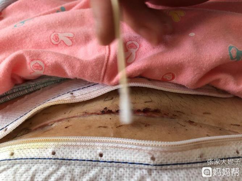 剖宫产伤口多久才不疼? 剖宫产伤口多久才不疼?