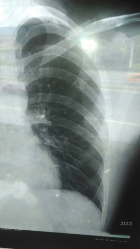 右胸有点闷疼是怎么回事 右胸有点闷疼是怎么回事